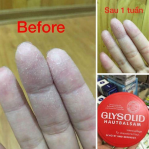 Kem Glysolid Trị Nứt Nẻ, Á Sừng Tay Chân